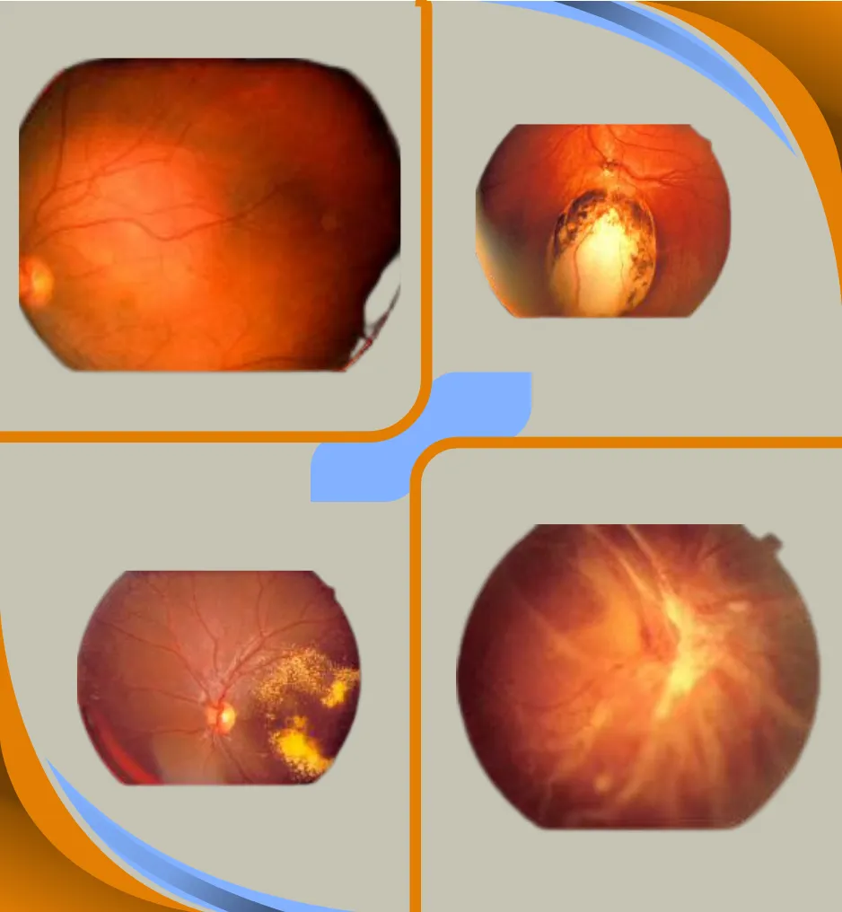 Viteroretinal